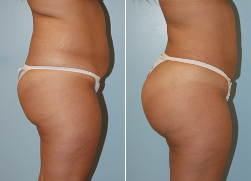 Brazilian Butt Lift Before and After