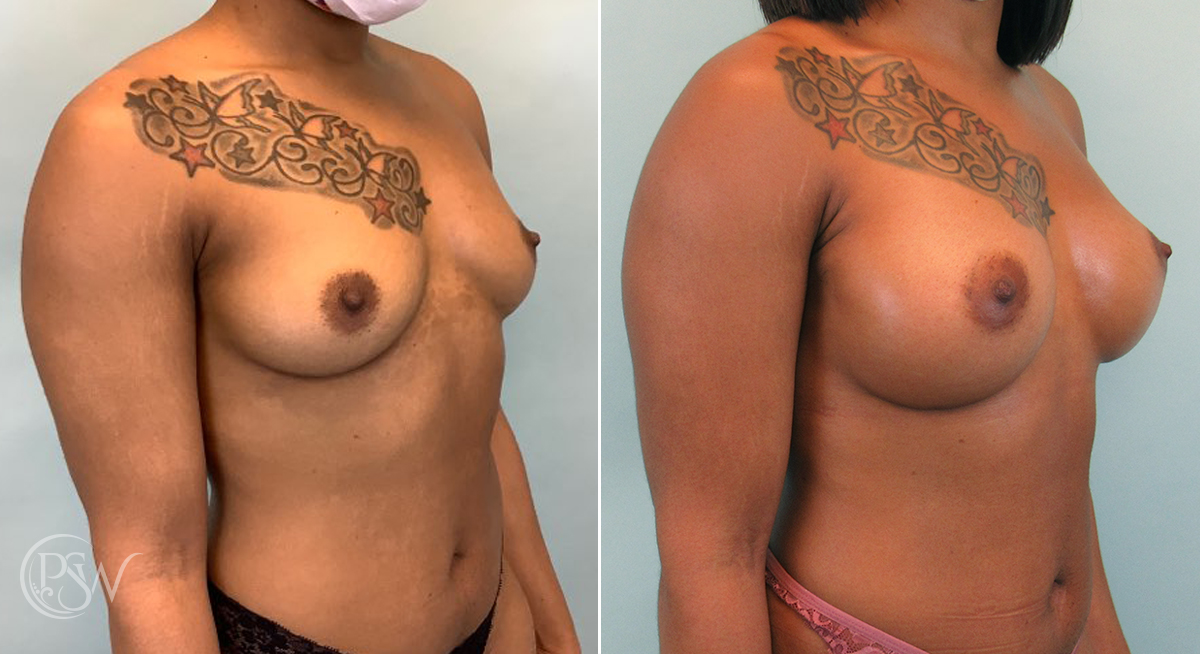 breast-augmentation