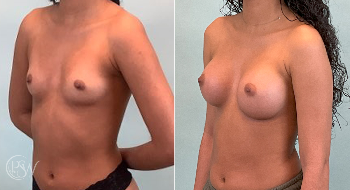 breast-augmentation