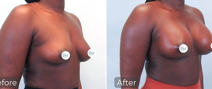 breast-augmentation-12-15-23