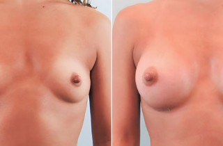 breast-augmentation-12-9-23