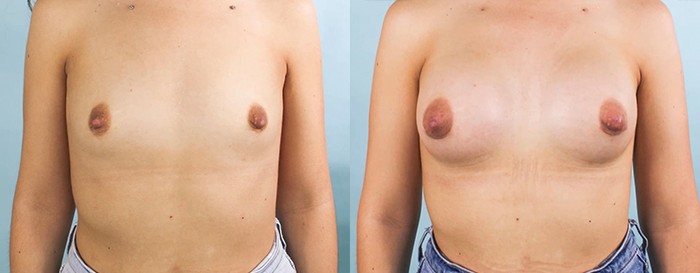 breast-aug-5-8