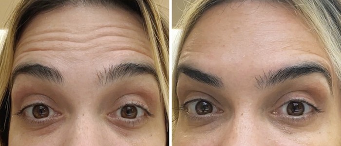10-24-dysport-injectables7