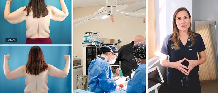 Augmentation-Mastopexy-Brachioplasty