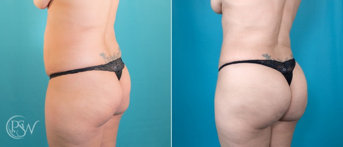 lipo360-bbl-5-17-25-3