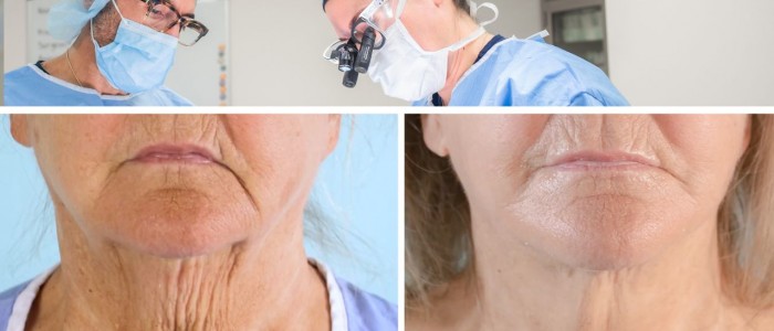 neck-lift-vs-face-lift