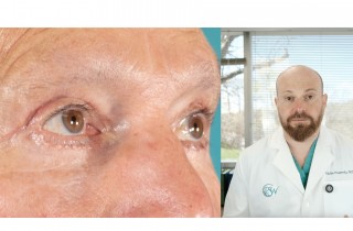 blepharoplasty-q-a