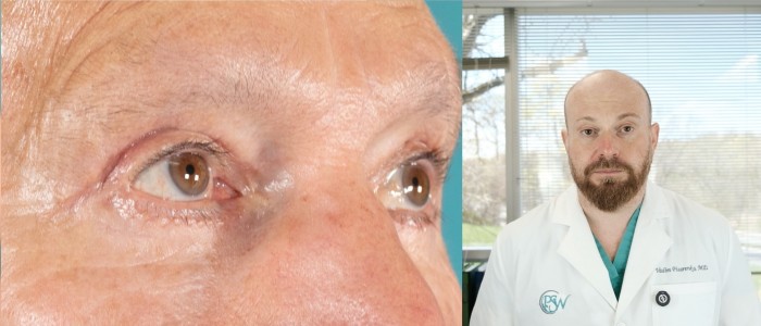 blepharoplasty-q-a