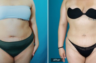 Breast Augmentation - 2