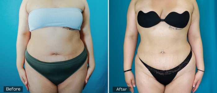 Breast Augmentation - 2