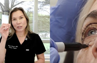 Upper Blepharoplasty While Awake! - 5