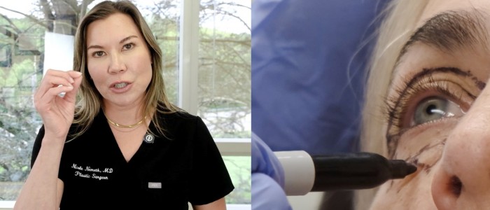 Upper Blepharoplasty While Awake! - 5