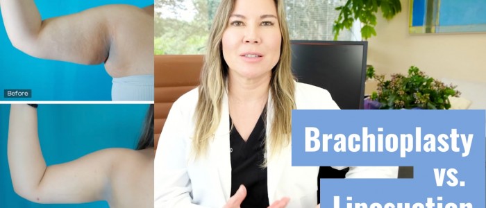 Brachioplasty vs Liposuction