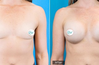 Breast Augmentation