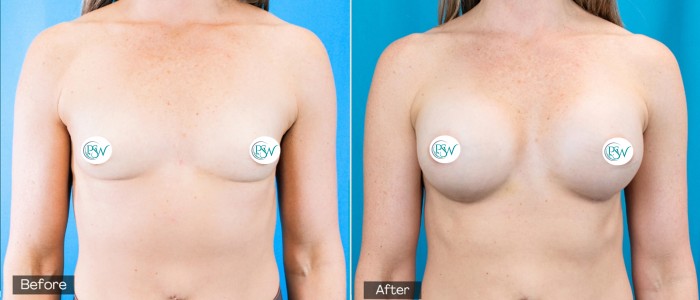 Breast Augmentation