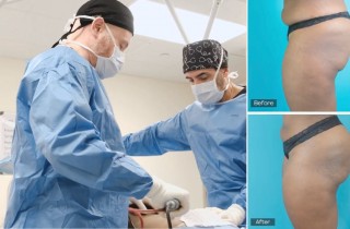 Upper Blepharoplasty While Awake! - 4