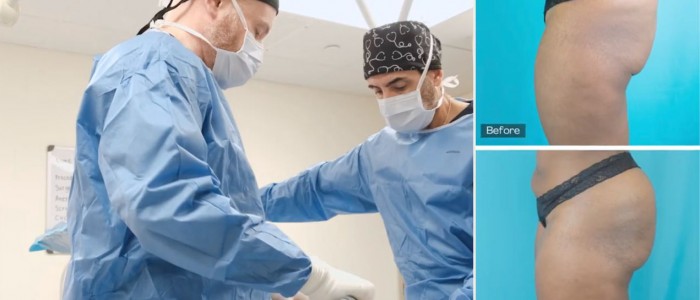 Upper Blepharoplasty While Awake! - 4