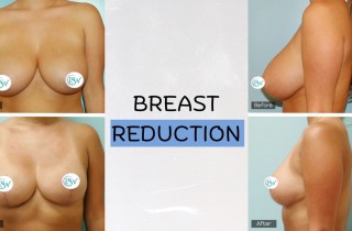 Upper Blepharoplasty While Awake! - 10