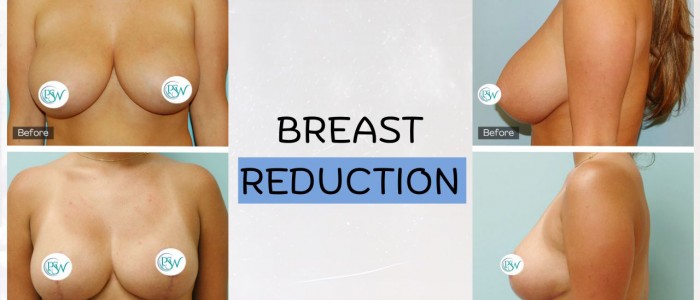 Upper Blepharoplasty While Awake! - 10