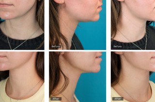 Upper Blepharoplasty While Awake! - 6