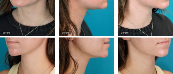 Upper Blepharoplasty While Awake! - 6