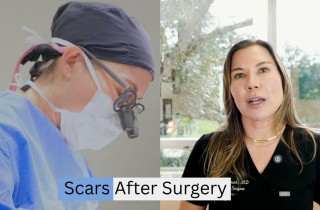 Upper Blepharoplasty While Awake! - 1