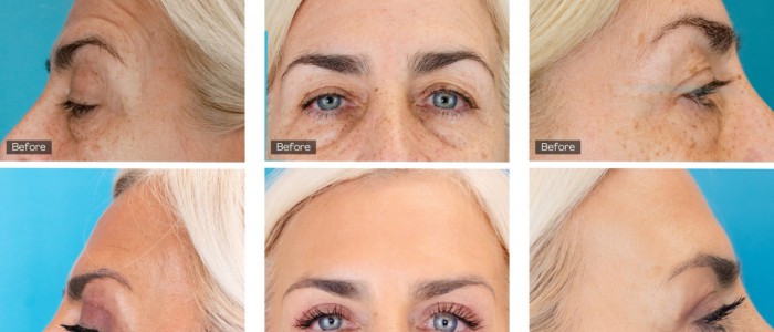 Upper Blepharoplasty While Awake! - 6