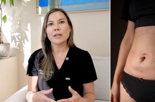 Upper Blepharoplasty While Awake! - 4