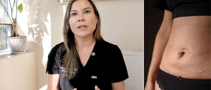 Upper Blepharoplasty While Awake! - 4