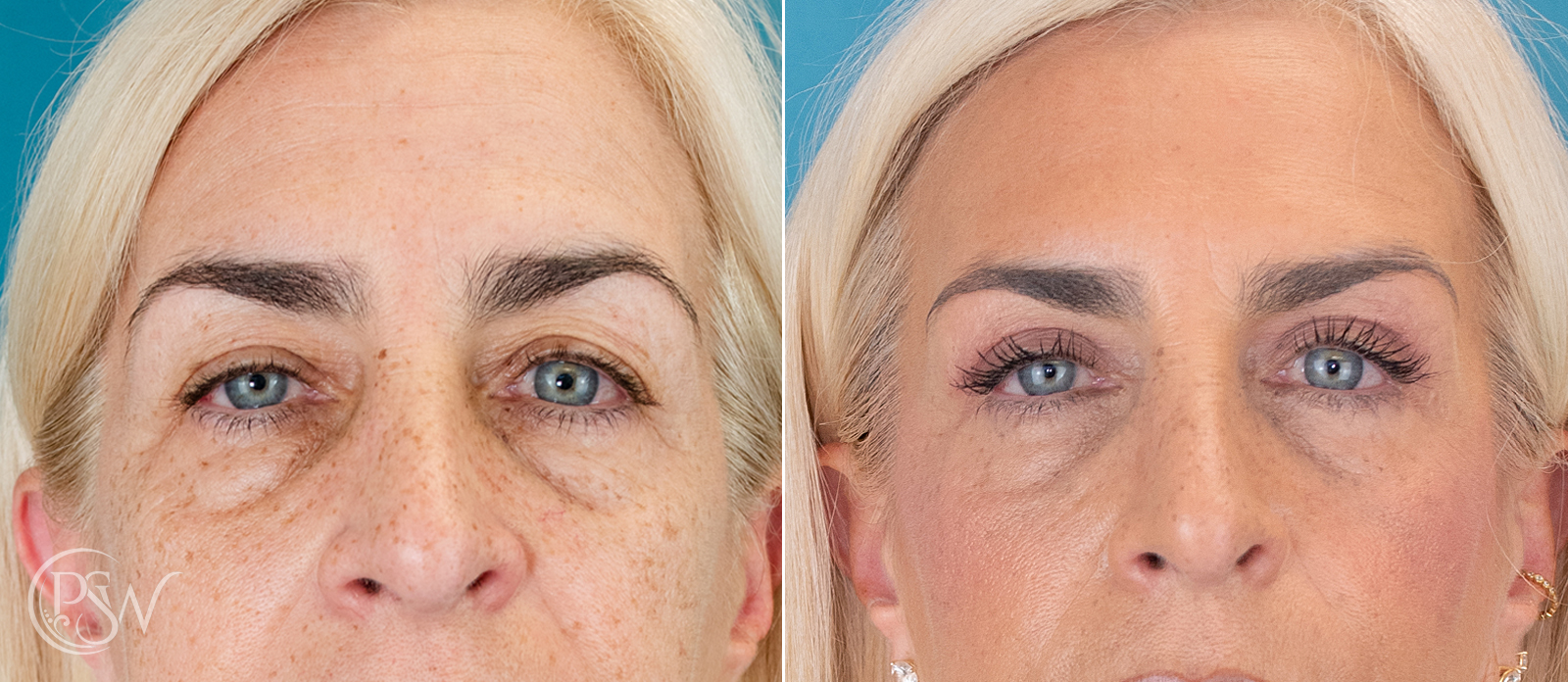 blepharoplasty