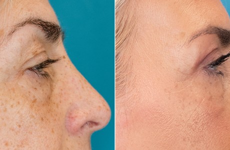 blepharoplasty-10-8.25-im2