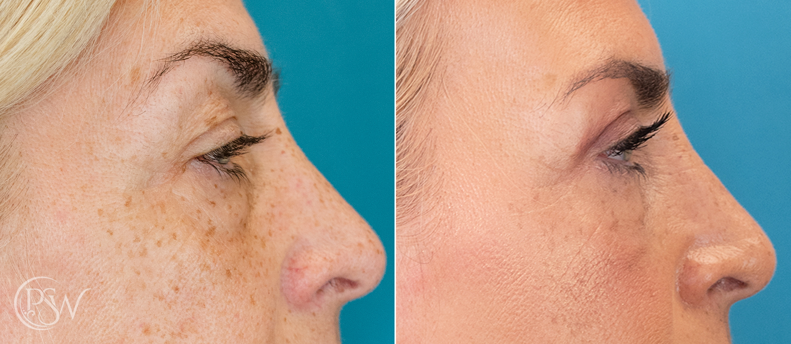 blepharoplasty