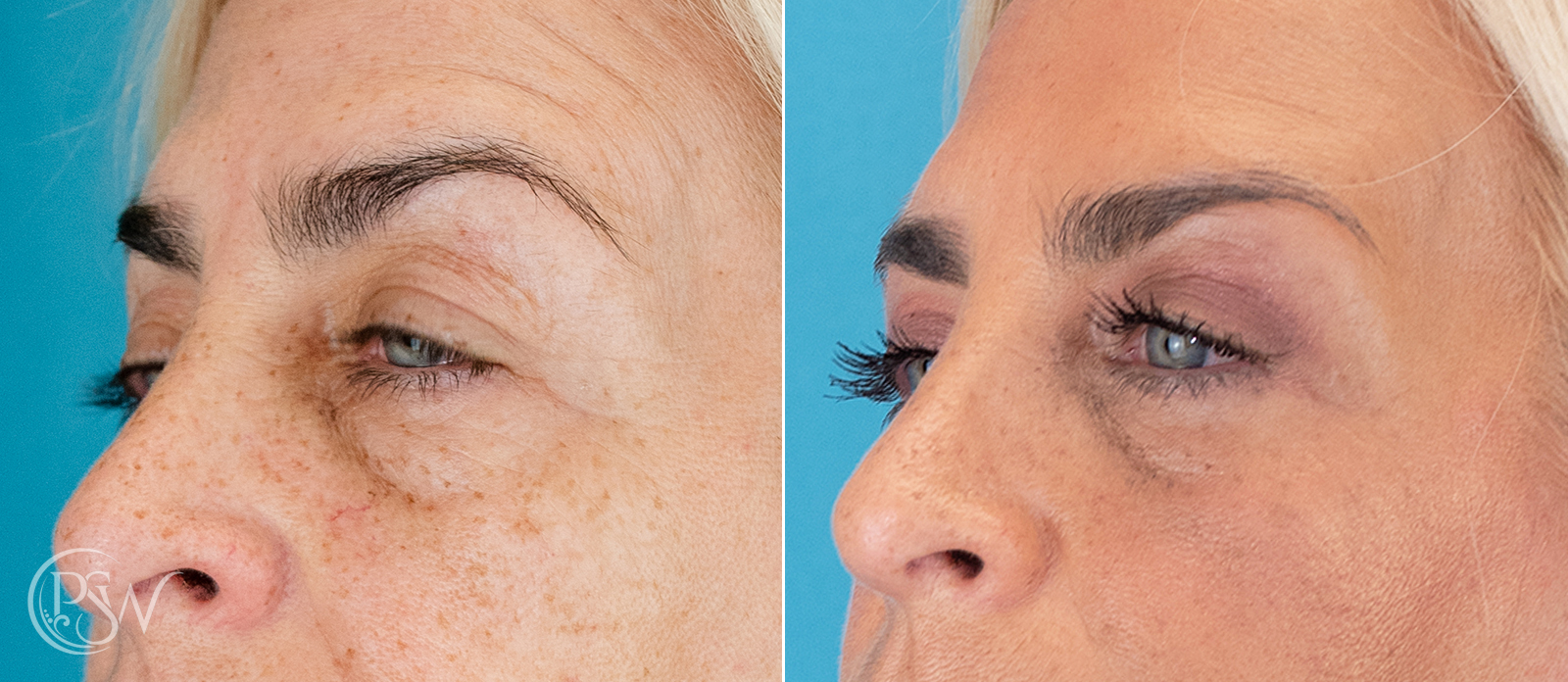 blepharoplasty