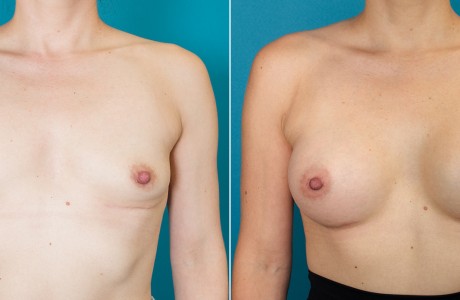 breast-augmentation-10.8.25-img1