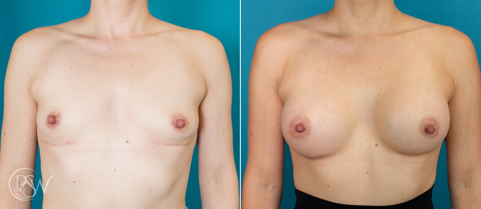 breast-augmentation