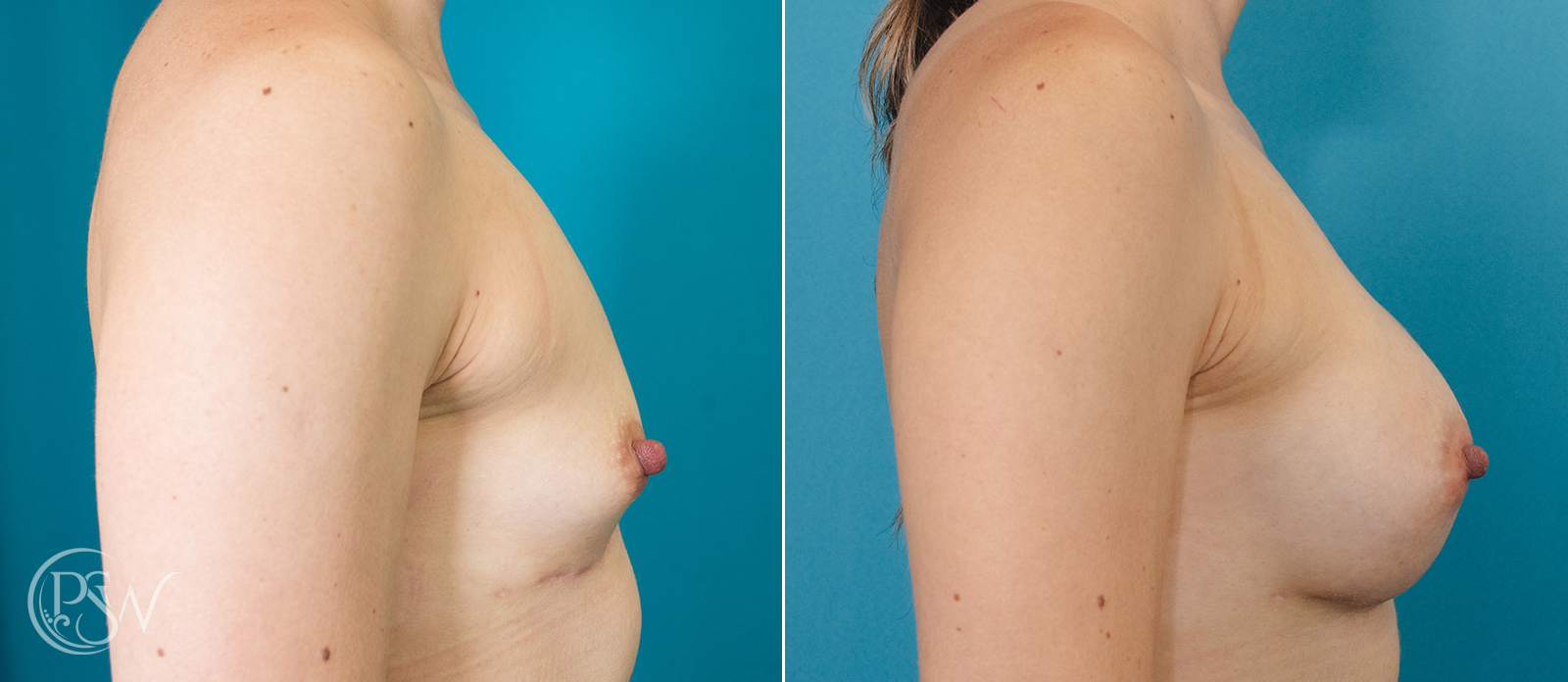 breast-augmentation