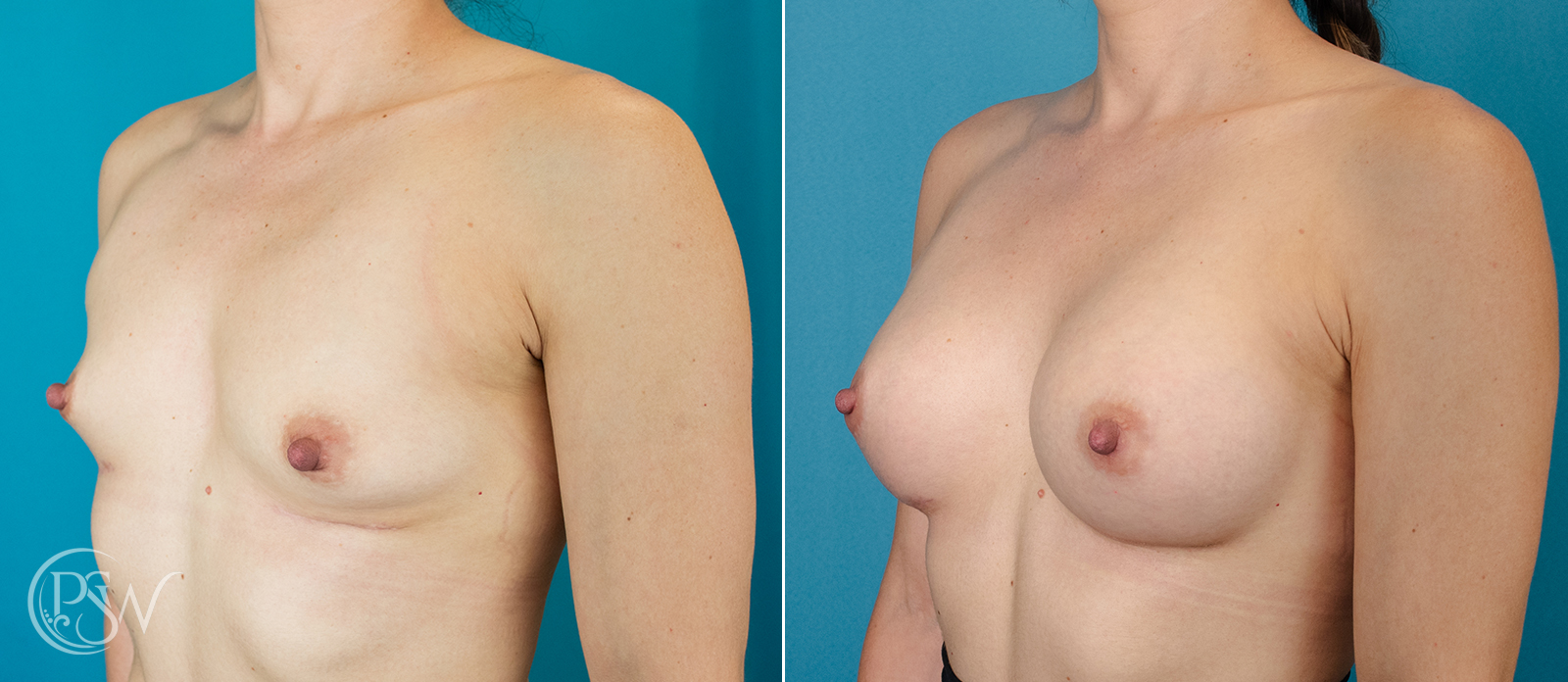 breast-augmentation