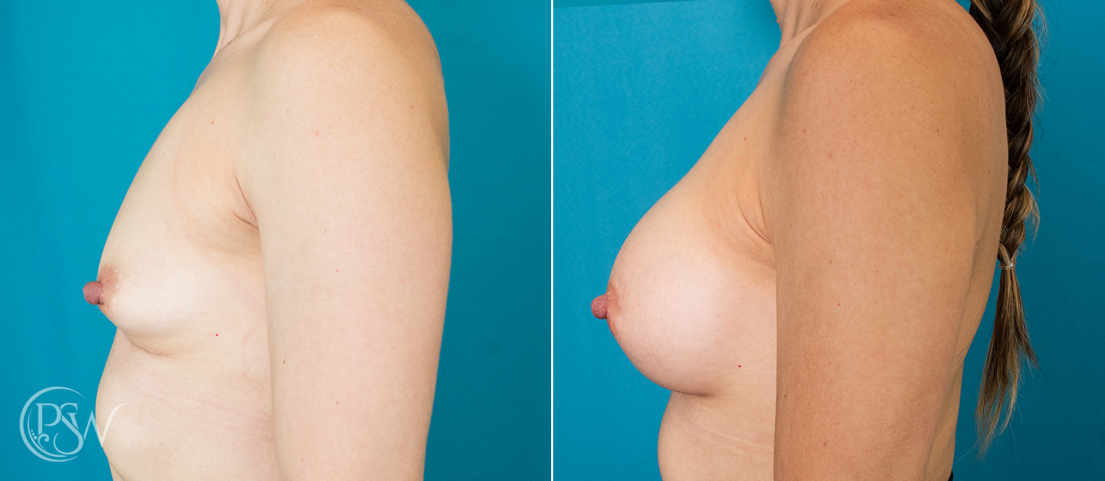 breast-augmentation