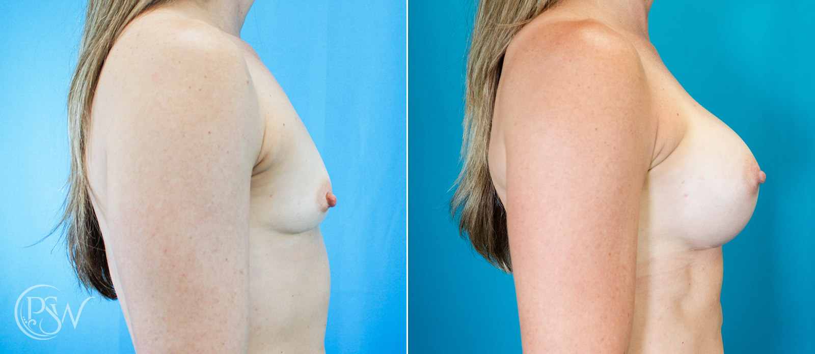 breast-augmentation