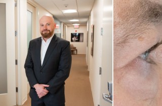 Upper Blepharoplasty While Awake! - 6