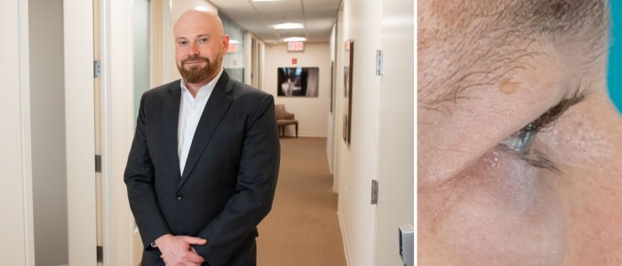 Upper Blepharoplasty While Awake! - 6