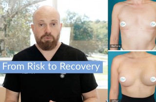 Upper Blepharoplasty While Awake! - 5