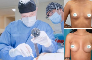 Upper Blepharoplasty While Awake! - 1