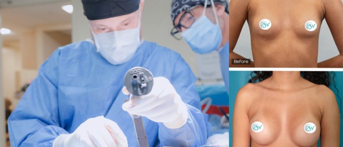 Upper Blepharoplasty While Awake! - 1