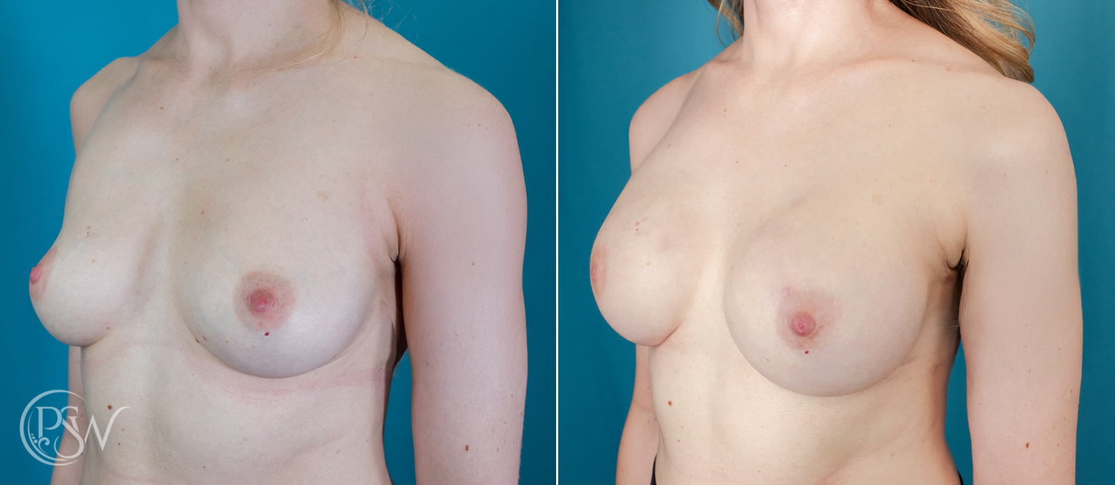 Bilateral-Breast-Reconstruction