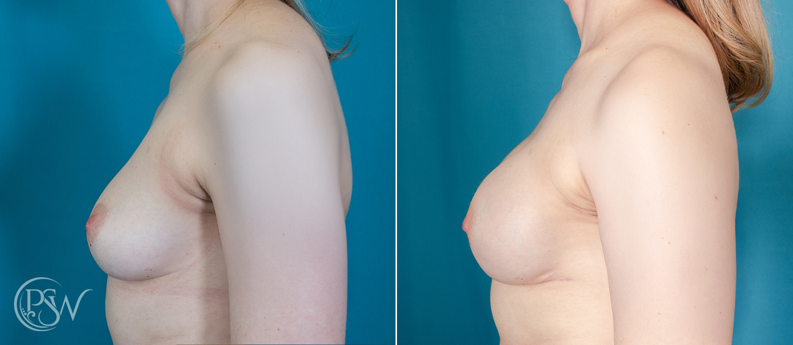 Bilateral-Breast-Reconstruction