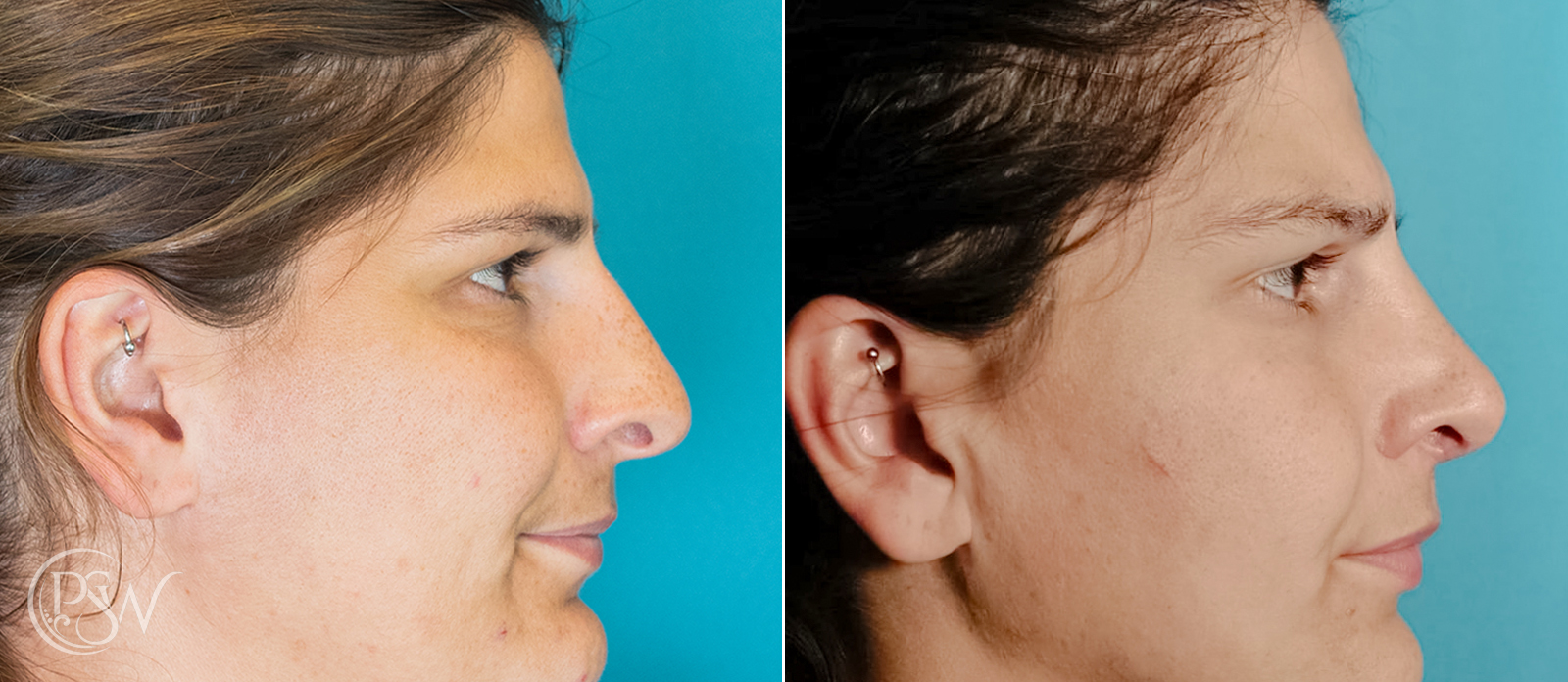 Rhinoplasty