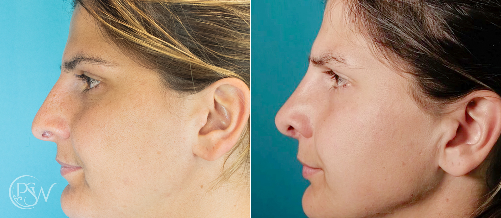 Rhinoplasty