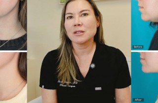 Upper Blepharoplasty While Awake! - 2