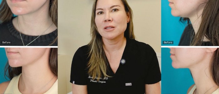 Upper Blepharoplasty While Awake! - 2